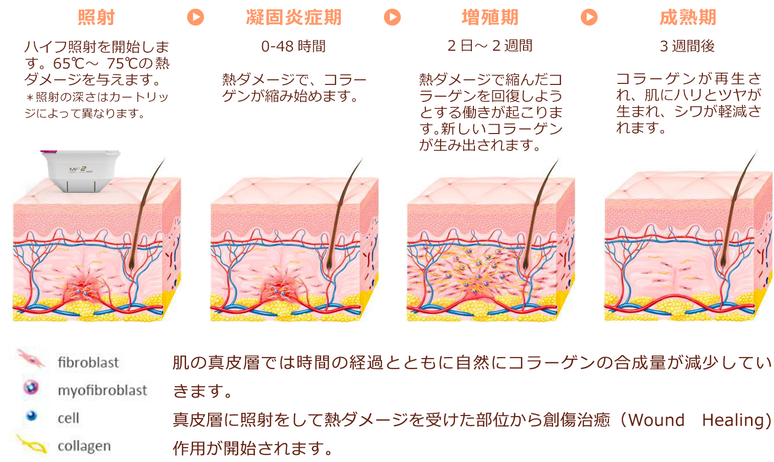 ハイフ治療とは