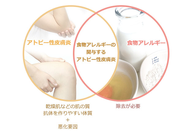食物アレルギーとアトピー性皮膚炎との関係