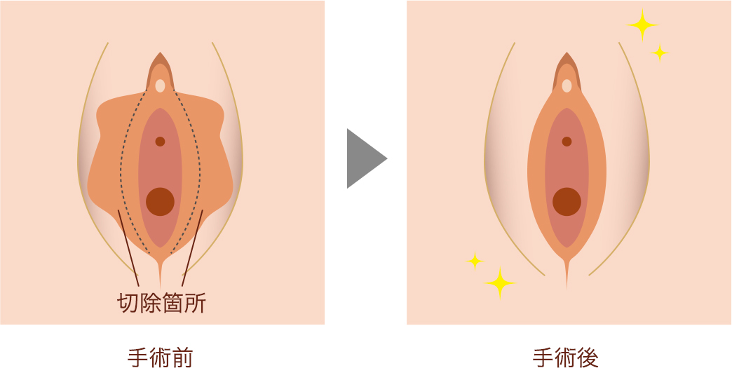 切除箇所