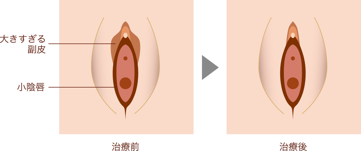 副皮切除術
