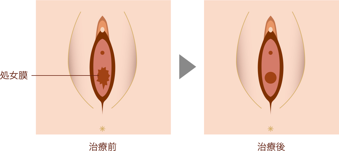 処女膜再生術