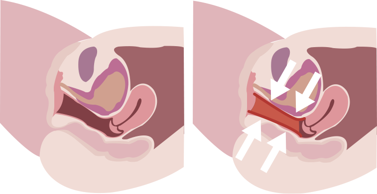 尿漏れ