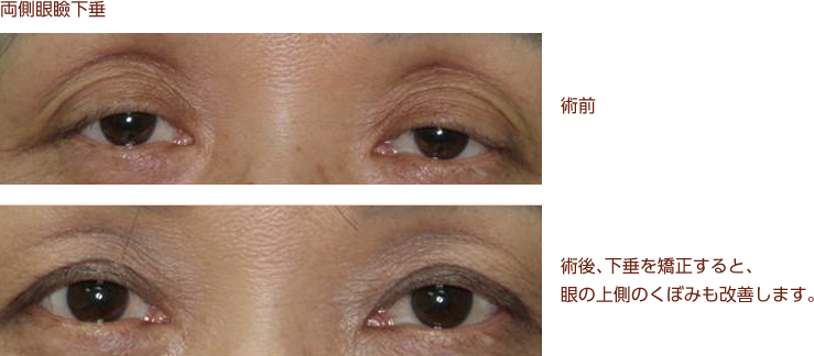 両側眼瞼下垂
