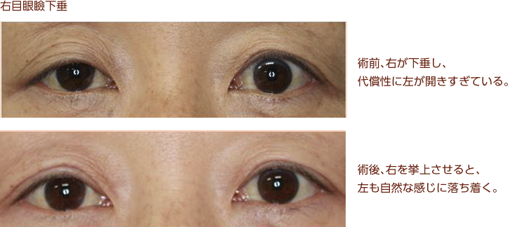 右目眼瞼下垂