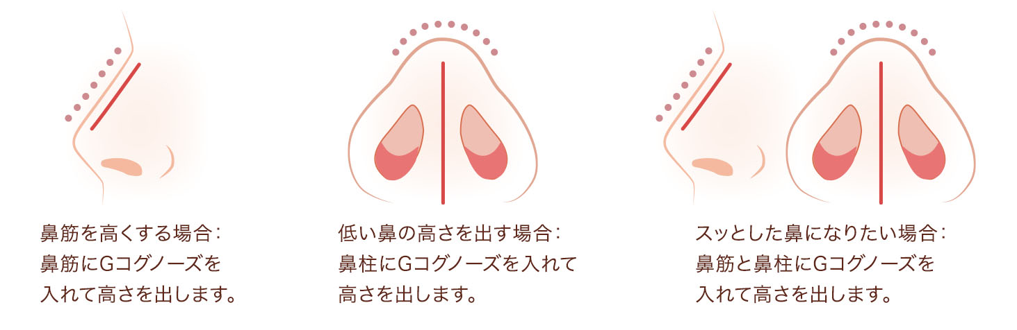 Gコグノーズ・Gメッシュはこんな方におすすめです