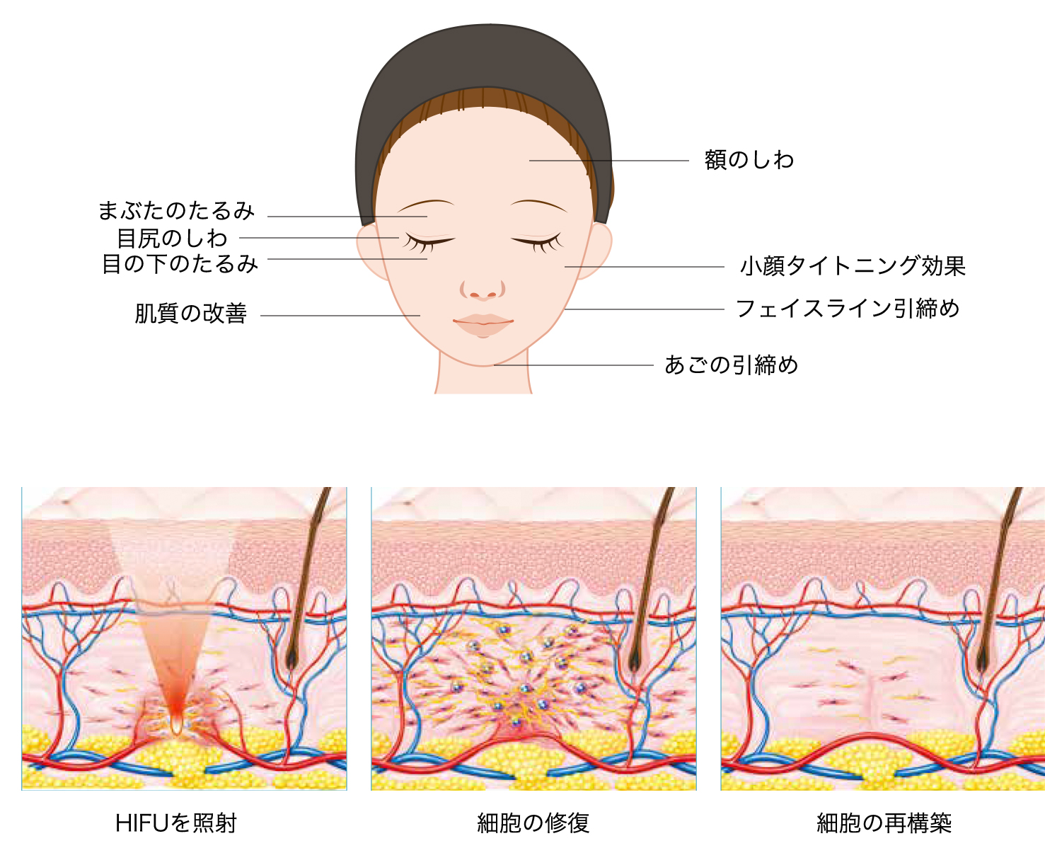 HIFUの特長