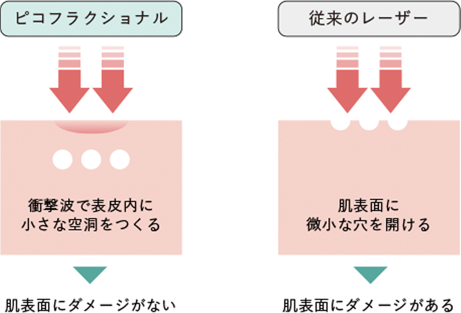ピコフラクショナル（ニキビ跡・毛穴・アンチエイジング）