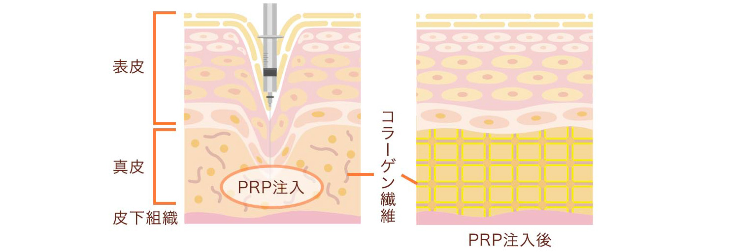 内側切開（内側のみの皮膚と粘膜を切開）