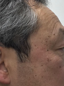 老人性疣贅