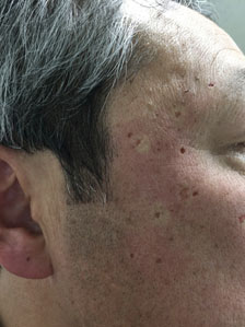 老人性疣贅