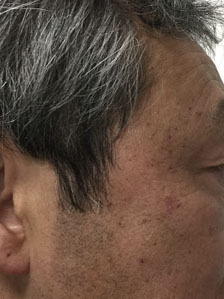老人性疣贅