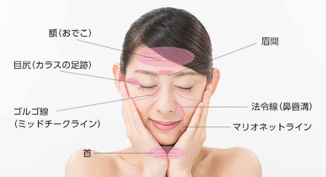 しわの種類