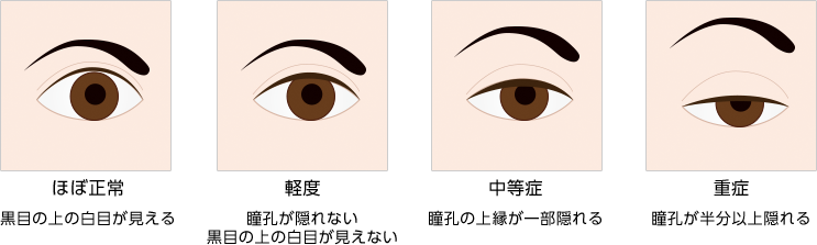 眼瞼下垂の重症度分類（最大限に目を開けた場合）